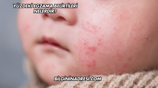 Yüzdeki Egzama Belirtileri Nelerdir?