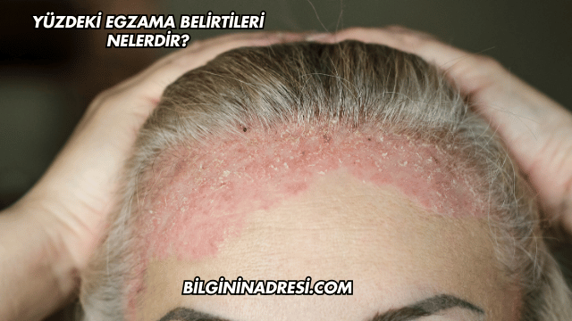 Yüzdeki Egzama Belirtileri Nelerdir?